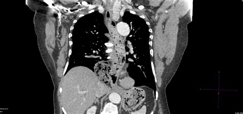 Case to Ponder 55 Answer: Epiphrenic Diverticulum - GrayscaleCourses.com