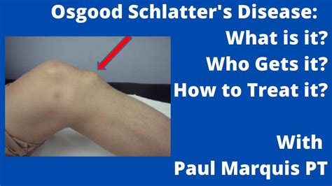 Osgood Schlatter's Disease: What is it? Who Gets it? How to Treat it? - YouTube