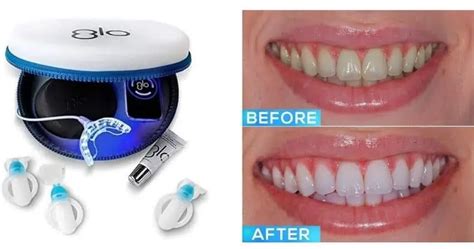 GLO Science Teeth Whitening Review: Does it Really Whiten? - Dentaly.org