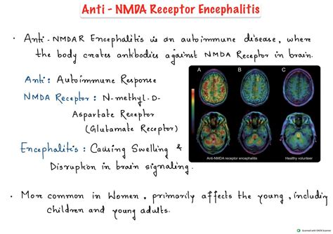 SOLUTION: Anti-NMDA Receptor Encephalitis Symptoms, Treatment Notes - Studypool