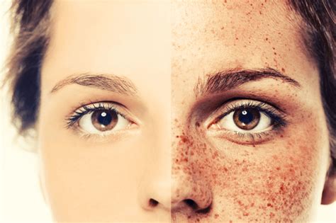 Freckles : Description, types, causes, prevalence, and treatment | FactDr