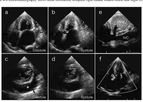 Transthoracic echocardiography on 4-chamber views (a and b) and short... | Download Scientific ...