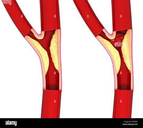 Atherosclerosis Aorta High Resolution Stock Photography and Images - Alamy