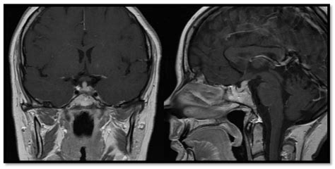 Pituitary Stalk Lesion Clinical Features - mapametawan