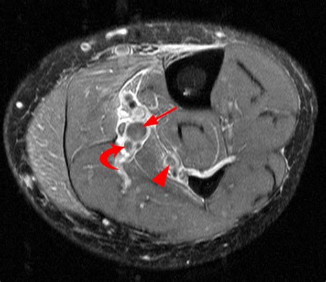 Deep Venous Thrombosis