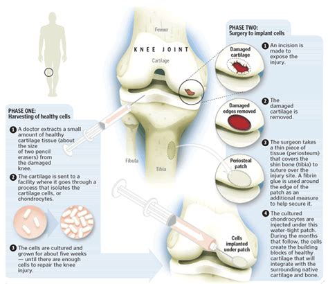 Cartilage Restoration for Sports Injuries - West Coast Orthopedics