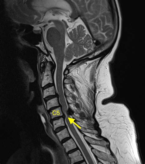 Cervical myelopathy - MRI - Radiology at St. Vincent's University Hospital