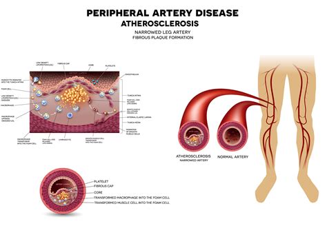 What is Peripheral Artery Disease (PAD)? - Imaging Center, Minimally ...