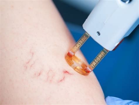 Laser vascular treatments and its benefits | Skin Clinic, Australia