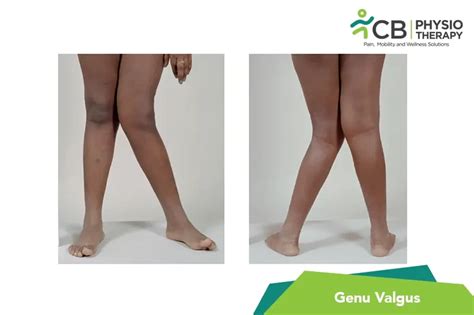 What Is Genu valgus?, Symptoms, Causes, Diagnosis & Physiotherapy Treatment Of Genu valgus.