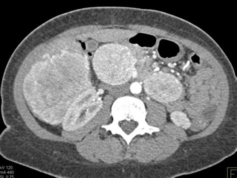 Functional Pancreatic Neuroendocrine Tumors Youtube