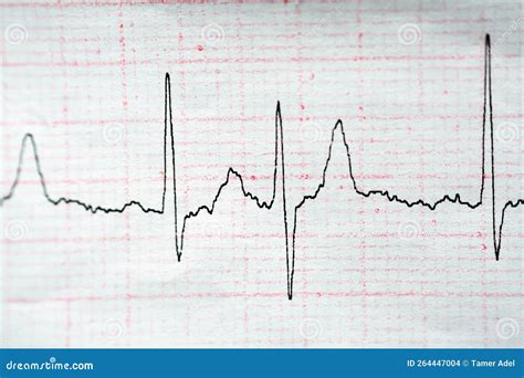 ECG ElectroCardioGraph Paper that Shows Normal Sinus Rhythm NSR with ...