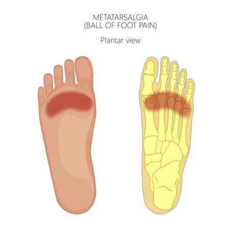 Foot pain - top 10 causes - MyDr.com.au