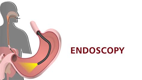 Endoscopy Procedure Colonoscopy Step by step Recovery Coimbatore