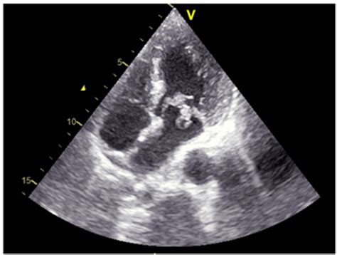 Infective Endocarditis Caused by Abiotrophia Defectiva : A Case Report