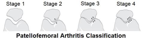 Patellofemoral Osteoarthritis