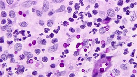 Cryptococcus Neoformans Gram Stain