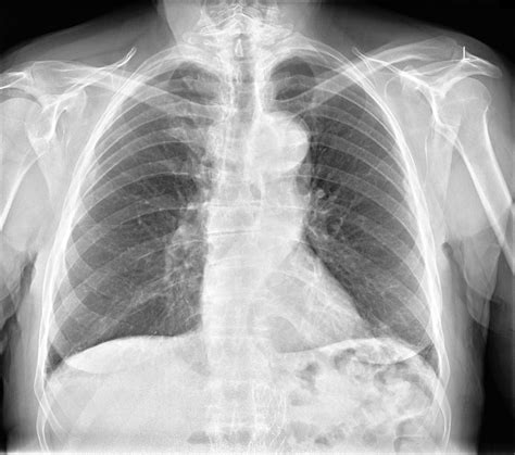 Aortic Knuckle | Chest X-Ray - MedSchool