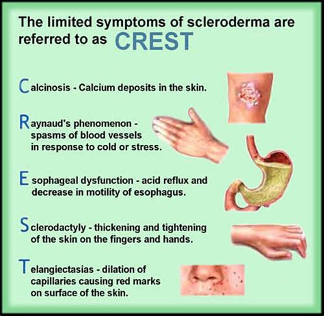 Scleroderma - Myositis Support and Understanding