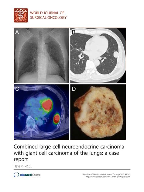 (PDF) Combined large cell neuroendocrine carcinoma with giant cell ...