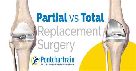 Partial vs Full Knee Replacement - Pontchartrain Orthopedics