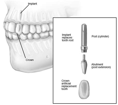 Dental Bridge - Procedure, Dental Bridge Vs Dental Implant