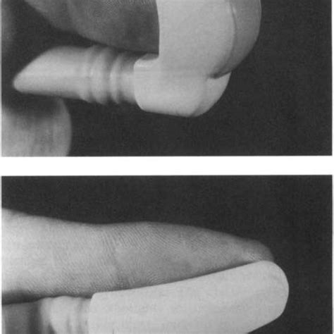 A left submandibular sialogram of the gland shown in Figure 3, showing ...