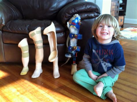 Children & Prosthetics ‹ News - Kenney Orthopedics - Orthotics ...