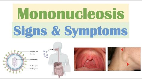 Infectious Mononucleosis (Mono) Signs & Symptoms - YouTube