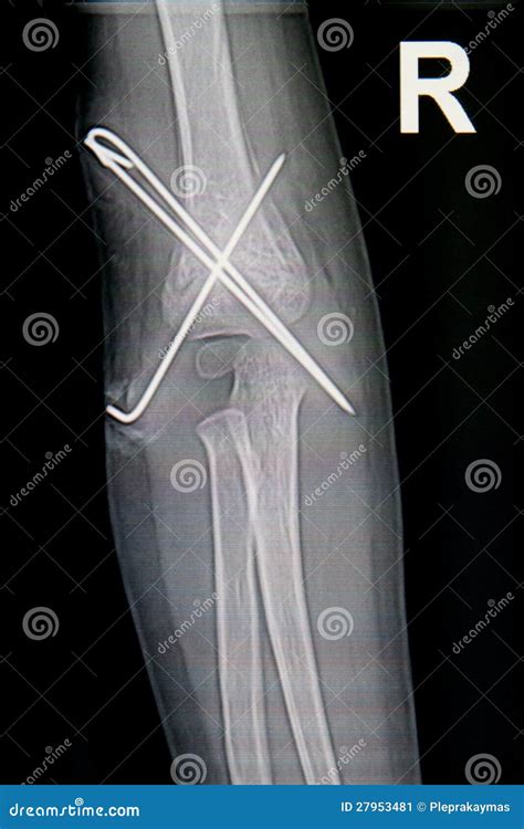 Forearm x-rays image stock image. Image of limb, radiogram - 27953481