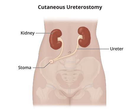 Ureterosigmoidostomy