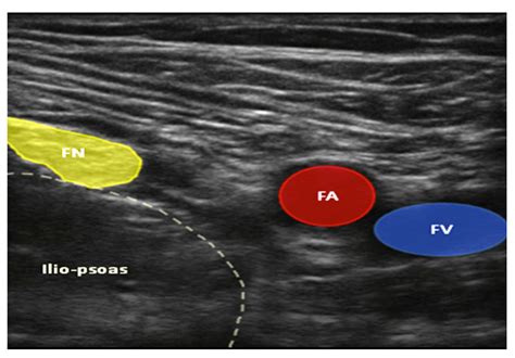 Ultrasound Guided Femoral Nerve Block : WFSA - Resources