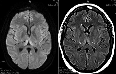 Brain MRI demonstrates symmetrical hyperintensities of the mammillary... | Download Scientific ...