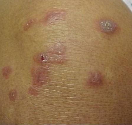 Sarcoidosis (cutaneous sarcoidosis) - Dermatology Advisor