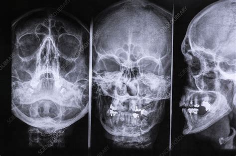 Paranasal sinuses, head X-rays - Stock Image - C023/8535 - Science Photo Library