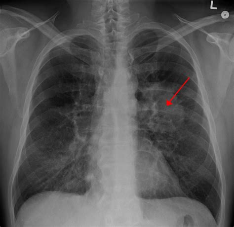 Asbestosis vs. Mesothelioma: 5 Facts You Need to Know