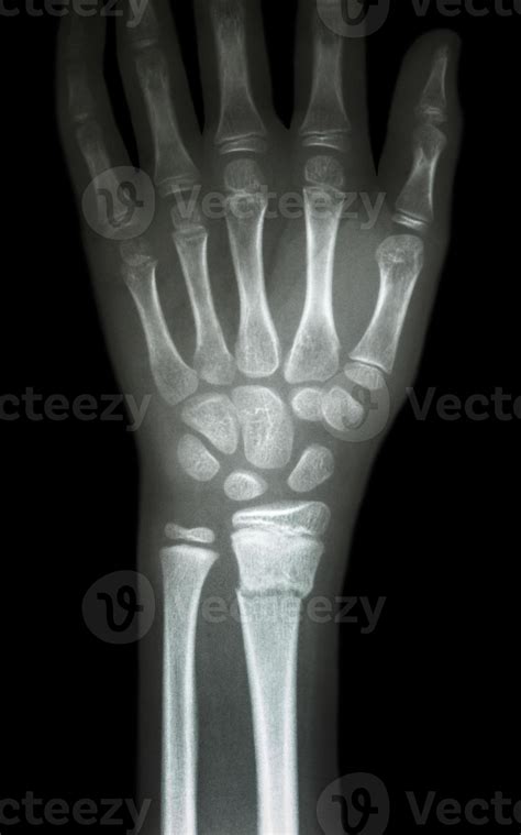 film x ray wrist show fracture distal radius forearm s bone 2465811 Stock Photo at Vecteezy