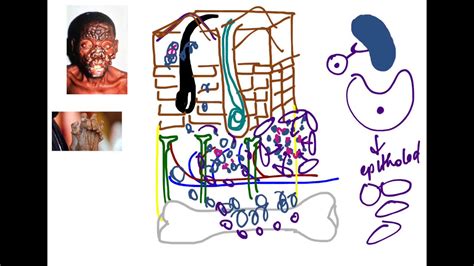 Mycobacterium Leprae - YouTube