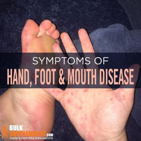 Pin by Marie Landers on Gift for him | Hand foot and mouth, Mouth sores, Disease