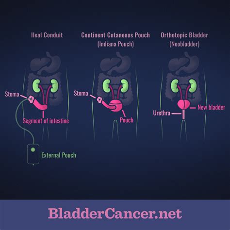 Recovery Time After Bladder Cancer Surgery - CancerWalls