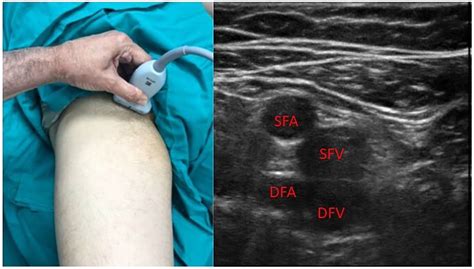 Ultrasound Guided Femoral Central Line Insertion Yout - vrogue.co