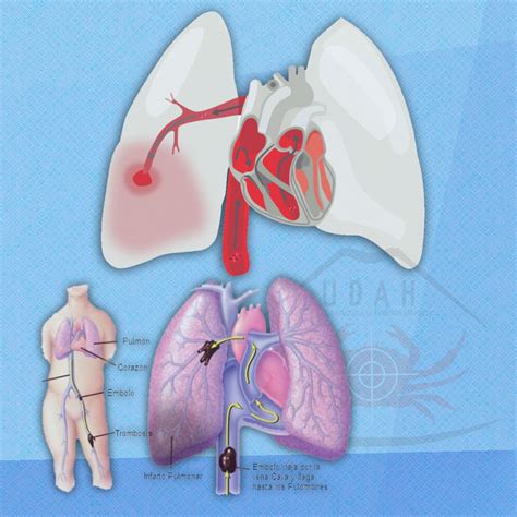 EMBOLIA PULMONAR