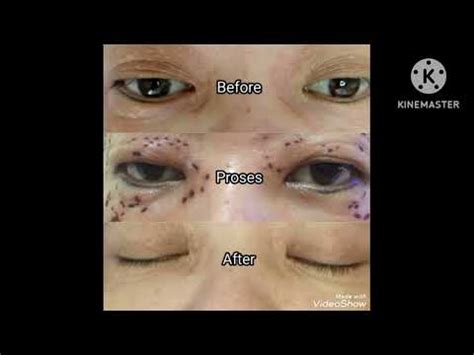 laser syringoma - YouTube