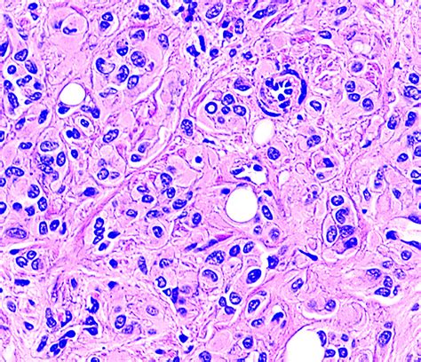 Pathology Outlines - Epithelioid hemangioendothelioma