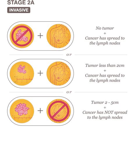 Stage 2 Breast Cancer Overview - National Breast Cancer Foundation