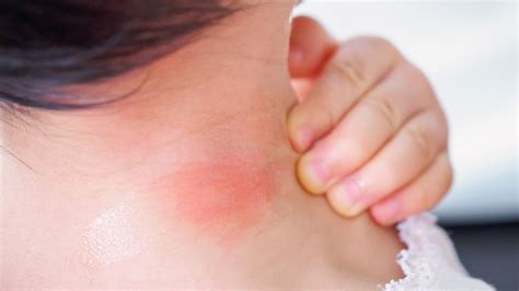 17 Signs Your Bug Bite Is Something Serious — Best Life
