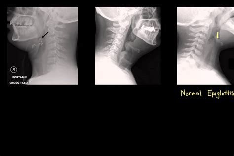 Epiglottitis: Diagnosis and Treatment - YouTube