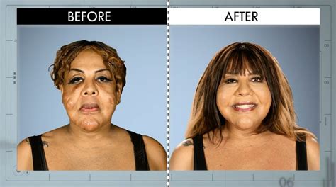 Concrete in Her Face from Botched Patients Before and After—Shocking Transformations!