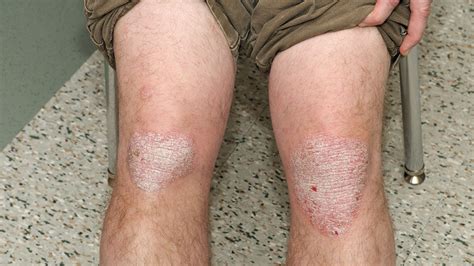 Is That Rash Psoriasis? Psoriasis Pictures and More | Everyday Health