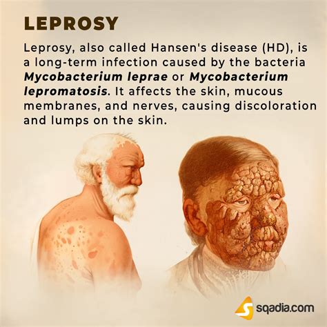 Leprosy | Medical facts, Medical education, Disease